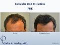 Follicular Unit Extraction (FUE) with Dr. Carlos K. Wesley in New York City. Before/After 2701 FUE grafts using a combination of 0.8mm and 0.9mm motorized punches.

The first postoperative week of this patient's experience with Dr. Wesley can be viewed here:
www.drcarloswesley.com/videos_11.html