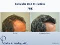 Follicular Unit Extraction (FUE) with Dr. Carlos K. Wesley in New York City. Before/After 2701 FUE grafts using a combination of 0.8mm and 0.9mm motorized punches.

The first postoperative week of this patient's experience with Dr. Wesley can be viewed here:
www.drcarloswesley.com/videos_11.html