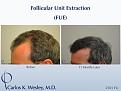 Follicular Unit Extraction (FUE) with Dr. Carlos K. Wesley in New York City. Before/After 2701 FUE grafts using a combination of 0.8mm and 0.9mm motorized punches.

The first postoperative week of this patient's experience with Dr. Wesley can be viewed here:
www.drcarloswesley.com/videos_11.html