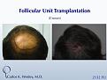 An interactive before/after image of this patient can be viewed at:
www.drcarloswesley.com/Crown_01.html

While much can be achieved when treating the vertex (crown) in a single session, this region may require more than one session to fully appreciate optimal coverage. Because of his above-average donor density as well as his ideal hair characteristics, this 46-yr-old man did obtain tremendous coverage with a single 2132-micrograft session to the crown.