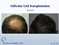 An interactive before/after image of this patient can be viewed at:
www.drcarloswesley.com/Crown_01.html

While much can be achieved when treating the vertex (crown) in a single session, this region may require more than one session to fully appreciate optimal coverage. Because of his above-average donor density as well as his ideal hair characteristics, this 46-yr-old man did obtain tremendous coverage with a single 2132-micrograft session to the crown.