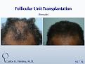 Female Patient Before/After a 917 grafts session with Dr. Carlos K. Wesley in NYC.

An interactive before/after image of this patient may be viewed at:
www.drcarloswesley.com/temporal_recessions01.html