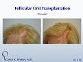 An interactive before/after image of this patient can be viewed at:

www.drcarloswesley.com/hairline06.html