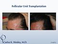 Before/After 2160 grafts
Dr. Carlos K. Wesley in New York City