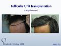 This 43-year-old man desired to reverse the progressive recession of his hairline. A total of 4480 grafts were transplanted to the frontal half of his scalp in order to create a natural-appearing hairline with considerable fullness.

A video of this patient's experience can be viewed here:
www.drcarloswesley.com/videos_17.html