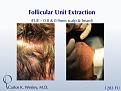 Images of the donor harvest from a 1283 FUE graft session from beard and scalp with Dr. Carlos K. Wesley in NYC.

An interactive before/after image can be viewed here:
www.drcarloswesley.com/improve_density04.html

A video of this patient's experience can be viewed here:
www.drcarloswesley.com/videos_08.html