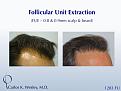 This patient had 1283 FUE grafts from beard and scalp with Dr. Carlos K. Wesley in NYC.

An interactive before/after image can be viewed here:
www.drcarloswesley.com/improve_density04.html

A video of this patient's experience can be viewed here:
www.drcarloswesley.com/videos_08.html