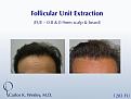 This patient had 1283 FUE grafts from beard and scalp with Dr. Carlos K. Wesley in NYC.

An interactive before/after image can be viewed here:
www.drcarloswesley.com/improve_density04.html

A video of this patient's experience can be viewed here:
www.drcarloswesley.com/videos_08.html