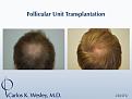 This 22-year-old can be seen before/after a 2265 grafts session to his mid scalp with Dr. Carlos K. Wesley

An interactive before/after image of this patient can be viewed at:
www.drcarloswesley.com/midscalp_03.html