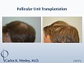 This 22-year-old can be seen before/after a 2265 grafts session to his mid scalp with Dr. Carlos K. Wesley

An interactive before/after image of this patient can be viewed at:
www.drcarloswesley.com/midscalp_03.html