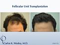 This 32-year-old male is seen before/after a 2565 graft session with Dr. Wesley in NYC.

Interactive before/after images of this patient may be seen here:
www.drcarloswesley.com/results.html

A video of this patient's experience can be viewed here:
www.drcarloswesley.com/videos_13.html