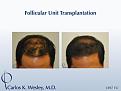 35-year-old male as seen before/after 1897 graft session with Dr. Carlos K. Wesley in NYC.

A video of this patient's experience can be viewed here:
www.drcarloswesley.com/videos_13.html