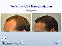 This 28-year-old desired the most natural appearing surgical hair restoration. He elected to have a session with Dr. Carlos K. Wesley in New York City. His 2276-graft session covered the frontal half of his scalp and he returned approximately nine (9) months later for images to be taken.  

View his transformation at: https://vimeo.com/67247877