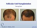 This 28-year-old desired the most natural appearing surgical hair restoration. He elected to have a session with Dr. Carlos K. Wesley in New York City. His 2276-graft session covered the frontal half of his scalp and he returned approximately nine (9) months later for images to be taken.  

View his transformation at: https://vimeo.com/67247877