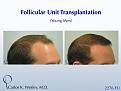 This 28-year-old desired the most natural appearing surgical hair restoration. He elected to have a session with Dr. Carlos K. Wesley in New York City. His 2276-graft session covered the frontal half of his scalp and he returned approximately nine (9) months later for images to be taken.  

View his transformation at: https://vimeo.com/67247877