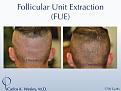 An example of short-term donor area recovery after follicular unit extraction (FUE) with Dr. Carlos K. Wesley (NYC).

A video montage of many more patients' FUE donor recoveries may be viewed at https://vimeo.com/70354892