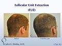 Early growth after this young man's 1701 graft FUE session with Dr. Carlos K. Wesley (NYC).  At only 7 months postoperatively, his recipient growth is beginning and his donor area is well healed.

Many more of Dr. Wesley's FUE patients donor areas may be viewed in this montage: https://vimeo.com/70354892