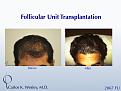 This patient had a session with Dr. Carlos K. Wesley (NYC) to increase the hair density throughout the frontal half of his scalp and improve the framing of his face.

http://www.drcarloswesley.com/videos_04.html