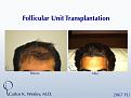 This patient had a session with Dr. Carlos K. Wesley (NYC) to increase the hair density throughout the frontal half of his scalp and improve the framing of his face.

http://www.drcarloswesley.com/videos_04.html