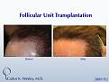 This patient had a session with Dr. Carlos K. Wesley (NYC) to increase the hair density throughout the frontal half of his scalp and improve the framing of his face.

An interactive video of this patient's transformation may be viewed here: https://vimeo.com/45812152