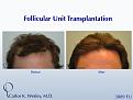 This patient had a session with Dr. Carlos K. Wesley (NYC) to increase the hair density throughout the frontal half of his scalp and improve the framing of his face.

An interactive video of this patient's transformation may be viewed here: https://vimeo.com/45812152