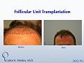 This patient presented to Dr. Carlos K. Wesley (NYC) for a hairline advancement.