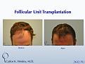 This patient presented to Dr. Carlos K. Wesley (NYC) for a hairline advancement.