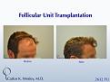 This patient presented to Dr. Carlos K. Wesley (NYC) for a hairline advancement.