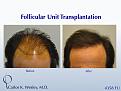 This patient's session with Carlos K. Wesley, M.D. (NYC) addressed both the frontal and mid scalp portions of his scalp.