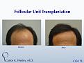 This patient's session with Carlos K. Wesley, M.D. (NYC) addressed both the frontal and mid scalp portions of his scalp.