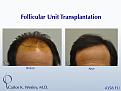 This patient's session with Carlos K. Wesley, M.D. (NYC) addressed both the frontal and mid scalp portions of his scalp.