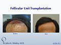 This patient's session with Carlos K. Wesley, M.D. (NYC) addressed both the frontal and mid scalp portions of his scalp.