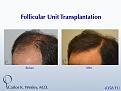 This patient's session with Carlos K. Wesley, M.D. (NYC) addressed both the frontal and mid scalp portions of his scalp.