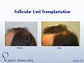 This patient's session with Carlos K. Wesley, M.D. (NYC) addressed both the frontal and mid scalp portions of his scalp.