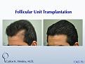 While not every patient is a candidate for this approach, this 46-year-old patient received a smaller, focused session to reinforce his temporal recessions that had been previously treated by another clinic with unsatisfactory results.

Using only 1365 grafts to add density specifically to these areas (and partially into surrounding areas of future loss), this patient, and others like him, may save not only donor hair for the future but also the financial cost of a larger session.

An interactive before