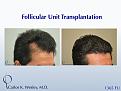 While not every patient is a candidate for this approach, this 46-year-old patient received a smaller, focused session to reinforce his temporal recessions that had been previously treated by another clinic with unsatisfactory results.

Using only 1365 grafts to add density specifically to these areas (and partially into surrounding areas of future loss), this patient, and others like him, may save not only donor hair for the future but also the financial cost of a larger session.

An interactive before