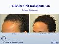 An interactive video montage of this patient may be viewed here: 

https://vimeo.com/39201138

An interactive before/after image of this female patient of Dr. Carlos K. Wesley (NYC) may be viewed here:

http://www.drcarloswesley.com/hairline02.html