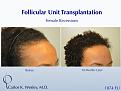 An interactive video montage of this patient may be viewed here: 

https://vimeo.com/39201138

An interactive before/after image of this female patient of Dr. Carlos K. Wesley (NYC) may be viewed here:

http://www.drcarloswesley.com/hairline02.html