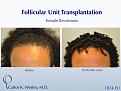 An interactive video montage of this patient may be viewed here: 

https://vimeo.com/39201138

An interactive before/after image of this female patient of Dr. Carlos K. Wesley (NYC) may be viewed here:

http://www.drcarloswesley.com/hairline02.html