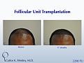 African-American male in his 30s underwent surgical hair restoration with Dr. Wesley (NYC).  Before and 11 months after a 2200 FU session.