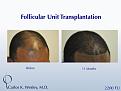 African-American male in his 30s underwent surgical hair restoration with Dr. Wesley (NYC).  Before and 11 months after a 2200 FU session.