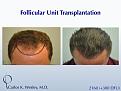 This 40-year old underwent surgical hair restoration with Dr. Carlos K. Wesley (NYC).  He received 2460 grafts (300 of which were DFUs) and presented 10 months postoperatively.