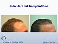 This 40-year old underwent surgical hair restoration with Dr. Carlos K. Wesley (NYC).  He received 2460 grafts (300 of which were DFUs) and presented 10 months postoperatively.