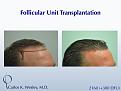 This 40-year old underwent surgical hair restoration with Dr. Carlos K. Wesley (NYC).  He received 2460 grafts (300 of which were DFUs) and presented 10 months postoperatively.
