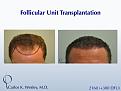 This 40-year old underwent surgical hair restoration with Dr. Carlos K. Wesley (NYC).  He received 2460 grafts (300 of which were DFUs) and presented 10 months postoperatively.