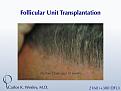 This 40-year old underwent surgical hair restoration with Dr. Carlos K. Wesley (NYC).  He received 2460 grafts (300 of which were DFUs) and presented 10 months postoperatively.