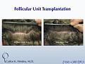 This 40-year old underwent surgical hair restoration with Dr. Carlos K. Wesley (NYC).  He received 2460 grafts (300 of which were DFUs) and presented 10 months postoperatively.