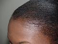 After Hair Transplant