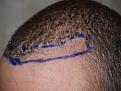 After FUE procedure