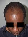 Before Hair Transplant